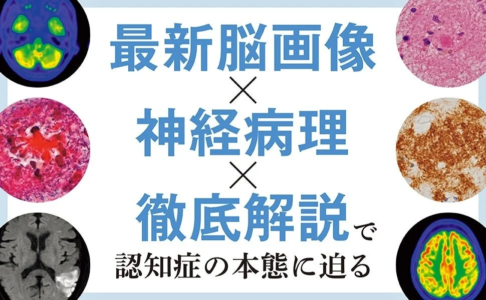 最新脳画像と神経病理による認知症解説